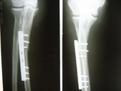 coimbatore-orthopaedic-joint-replacement-maternity-child-welfare-centre-india